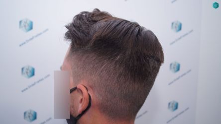 Injerto Capilar Técnica FUE Grafts 1852 (4121 Pelos) 25 RESULTADOS A LOS 12 MESES