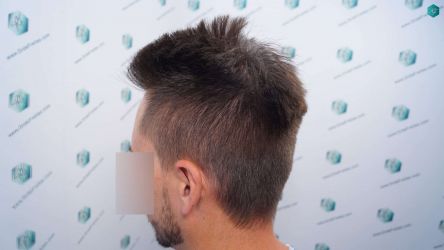 Injerto Capilar Técnica FUE Grafts 1852 (4121 Pelos) 2 Injerto Capilar Técnica FUE Grafts 1852 (4121 Pelos)