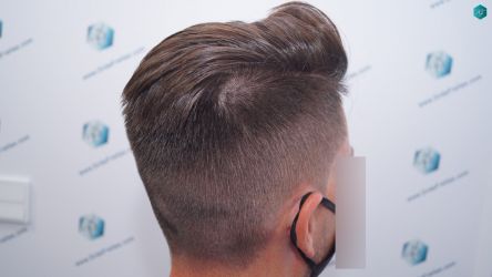 Injerto Capilar Técnica FUE Grafts 1852 (4121 Pelos) 26 30 EN 12 MESES