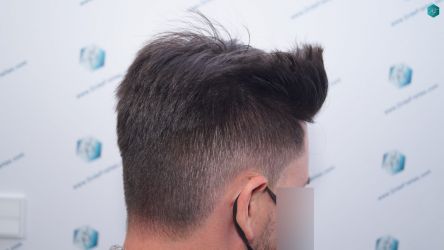 Injerto Capilar Técnica FUE Grafts 1852 (4121 Pelos) 27 31 EN 12 MESES