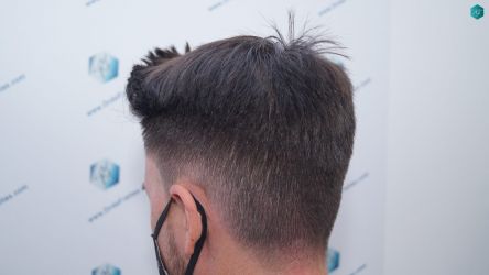 Injerto Capilar Técnica FUE Grafts 1852 (4121 Pelos) 28 32 EN 12 MESES