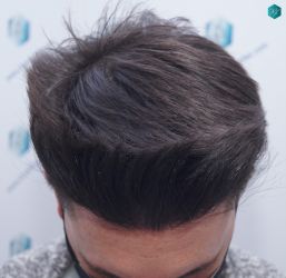 Injerto Capilar Técnica FUE Grafts 1852 (4121 Pelos) 29 33 EN 12 MESES