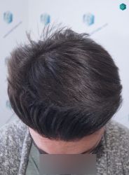 Injerto Capilar Técnica FUE Grafts 1852 (4121 Pelos) 30 34 EN 12 MESES