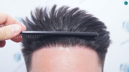 Injerto Capilar Técnica FUE Grafts 1852 (4121 Pelos) 31 35 EN 12 MESES
