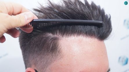 Injerto Capilar Técnica FUE Grafts 1852 (4121 Pelos) 32 36 EN 12 MESES
