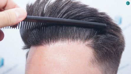Injerto Capilar Técnica FUE Grafts 1852 (4121 Pelos) 33 37 EN 12 MESES