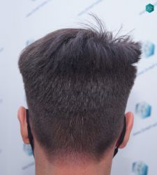 Injerto Capilar Técnica FUE Grafts 1852 (4121 Pelos) 34 38 EN 12 MESES