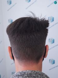 Injerto Capilar Técnica FUE Grafts 1852 (4121 Pelos) 35 39 EN 12 MESES