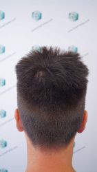 Injerto Capilar Técnica FUE Grafts 1852 (4121 Pelos) 3 Injerto Capilar Técnica FUE Grafts 1852 (4121 Pelos)