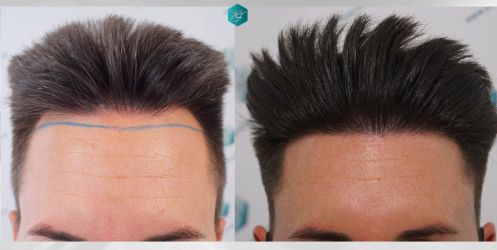 ANTES Y DESPUÉS ANTES Y DESPUÉS