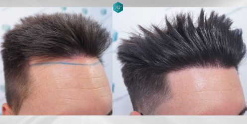 Injerto Capilar Técnica FUE Grafts 1852 (4121 Pelos) 36 41 COMPARATIVAS