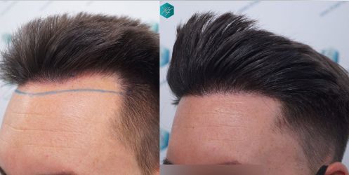 Injerto Capilar Técnica FUE Grafts 1852 (4121 Pelos) 37 42 COMPARATIVAS