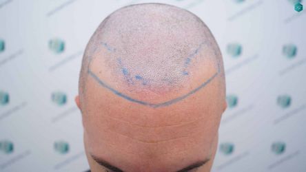 Injerto Capilar Técnica FUE Grafts 1852 (4121 Pelos) 8 Injerto Capilar Técnica FUE Grafts 1852 (4121 Pelos)
