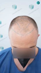 Injerto Capilar Técnica FUE Grafts 3021 (6242 Pelos) 10 LINEA DE INJERTO