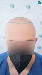Injerto Capilar Técnica FUE Grafts 3021 (6242 Pelos) 11 LINEA DE INJERTO