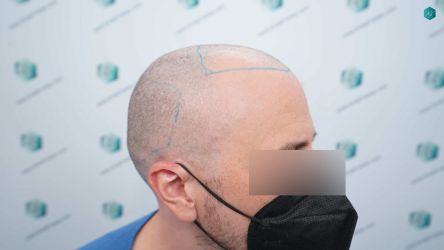 Injerto Capilar Técnica FUE Grafts 3021 (6242 Pelos) 13 LINEA DE INJERTO