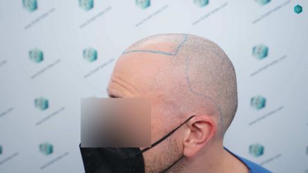Injerto Capilar Técnica FUE Grafts 3021 (6242 Pelos) 14 LINEA DE INJERTO