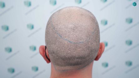 Injerto Capilar Técnica FUE Grafts 3021 (6242 Pelos) 15 15 DISENO LINEA INJERTO