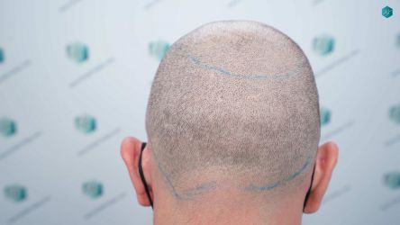 Injerto Capilar Técnica FUE Grafts 3021 (6242 Pelos) 16 17 DISENO LINEA INJERTO