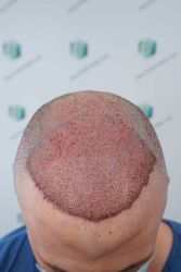 Injerto Capilar Técnica FUE Grafts 3021 (6242 Pelos) 17 19 TRASPLANTE CAPILAR