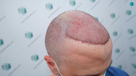 Injerto Capilar Técnica FUE Grafts 3021 (6242 Pelos) 18 20 TRASPLANTE CAPILAR
