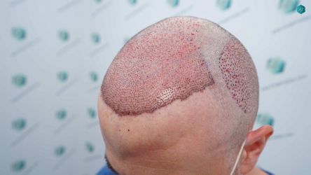 Injerto Capilar Técnica FUE Grafts 3021 (6242 Pelos) 21 21 TRASPLANTE CAPILAR
