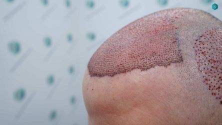 Injerto Capilar Técnica FUE Grafts 3021 (6242 Pelos) 22 21A TRASPLANTE CAPILAR