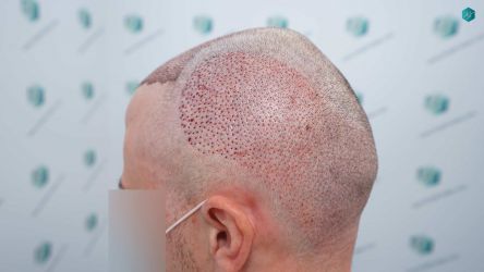 Injerto Capilar Técnica FUE Grafts 3021 (6242 Pelos) 23 21B TRASPLANTE CAPILAR