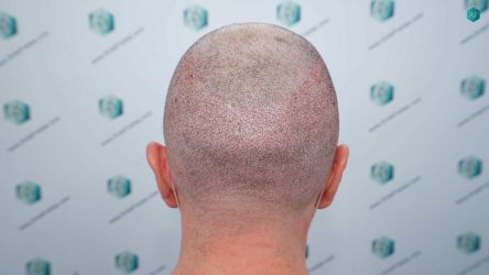Injerto Capilar Técnica FUE Grafts 3021 (6242 Pelos) 24 22 TRASPLANTE CAPILAR