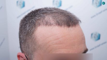 Injerto Capilar Técnica FUE Grafts 3021 (6242 Pelos) 25 24 RESULTADOS A LOS 3 MESES