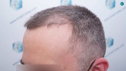 Injerto Capilar Técnica FUE Grafts 3021 (6242 Pelos) 26 25 RESULTADOS A LOS 3 MESES