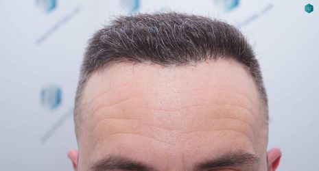 Injerto Capilar Técnica FUE Grafts 3021 (6242 Pelos) 27 26AA RESULTADOS A LOS 6 MESES