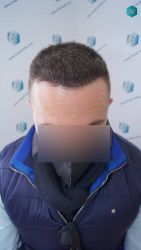 Injerto Capilar Técnica FUE Grafts 3021 (6242 Pelos) 28 26AB RESULTADOS A LOS 6 MESES
