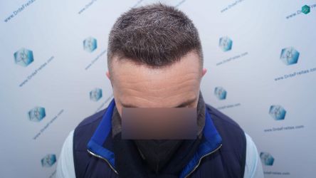 Injerto Capilar Técnica FUE Grafts 3021 (6242 Pelos) 29 27A RESULTADOS A LOS 6 MESES