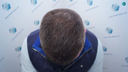 Injerto Capilar Técnica FUE Grafts 3021 (6242 Pelos) 30 27B RESULTADOS A LOS 6 MESES