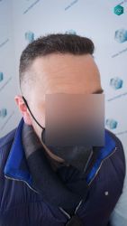 Injerto Capilar Técnica FUE Grafts 3021 (6242 Pelos) 31 28 RESULTADOS A LOS 6 MESES
