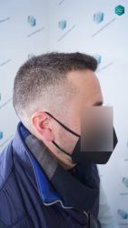 Injerto Capilar Técnica FUE Grafts 3021 (6242 Pelos) 32 29 RESULTADOS A LOS 6 MESES