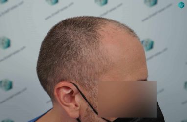 Injerto Capilar Técnica FUE Grafts 3021 (6242 Pelos) 2 Injerto Capilar Técnica FUE Grafts 3021 (6242 Pelos)