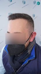 Injerto Capilar Técnica FUE Grafts 3021 (6242 Pelos) 33 30 RESULTADOS A LOS 6 MESES