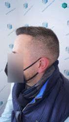 Injerto Capilar Técnica FUE Grafts 3021 (6242 Pelos) 34 31 RESULTADOS A LOS 6 MESES
