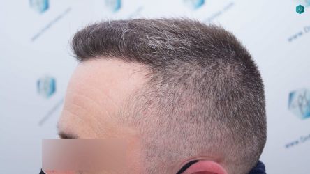 Injerto Capilar Técnica FUE Grafts 3021 (6242 Pelos) 35 32 RESULTADOS A LOS 6 MESES