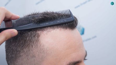 Injerto Capilar Técnica FUE Grafts 3021 (6242 Pelos) 37 34 RESULTADOS A LOS 6 MESES