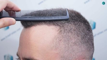 Injerto Capilar Técnica FUE Grafts 3021 (6242 Pelos) 38 35 RESULTADOS A LOS 6 MESES