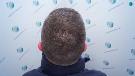 Injerto Capilar Técnica FUE Grafts 3021 (6242 Pelos) 39 37 RESULTADOS A LOS 6 MESES