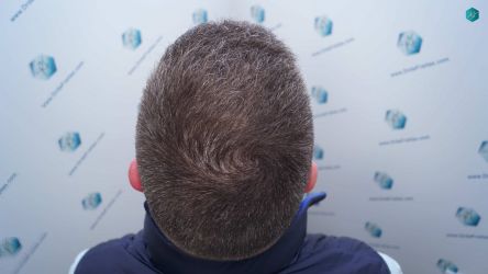 Injerto Capilar Técnica FUE Grafts 3021 (6242 Pelos) 40 38 RESULTADOS A LOS 6 MESES