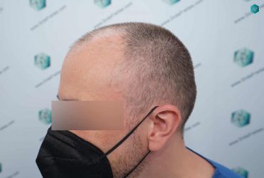 Injerto Capilar Técnica FUE Grafts 3021 (6242 Pelos) 5 Injerto Capilar Técnica FUE Grafts 3021 (6242 Pelos)
