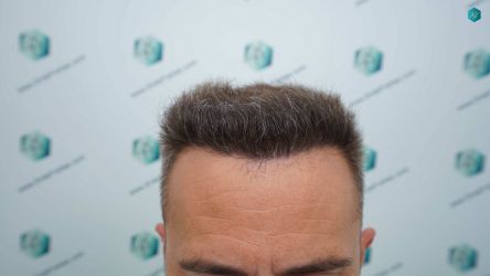 Injerto Capilar Técnica FUE Grafts 3021 (6242 Pelos) 41 41 RESULTADOS A LOS 12 MESES