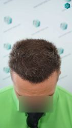 Injerto Capilar Técnica FUE Grafts 3021 (6242 Pelos) 42 41A RESULTADOS A LOS 12 MESES