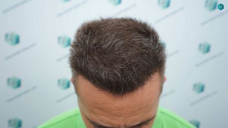 Injerto Capilar Técnica FUE Grafts 3021 (6242 Pelos) 43 41B RESULTADOS A LOS 12 MESES