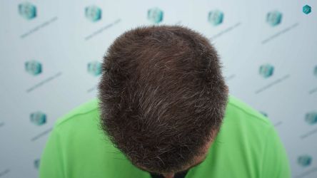 Injerto Capilar Técnica FUE Grafts 3021 (6242 Pelos) 44 41E RESULTADOS A LOS 12 MESES
